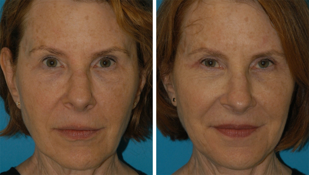 Facelift, Blepharoplasty, Embrace RF and Restylane Injections to Rejuvenate the Face hooded eyes patient before and after
