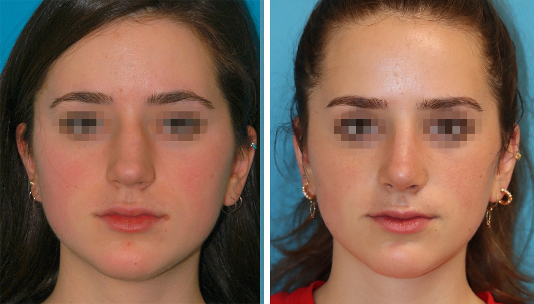 Rhinoplasty to Enhance Nose Shape two weeks after rhinoplasty results