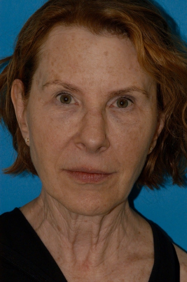 anti-aging-treatments-princeton-nj anti aging treatment in princeton, nj