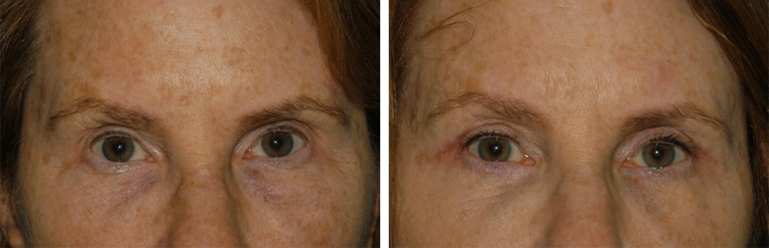 blepharoplasty-eye-surgery-princeton-nj blepharoplasty eye surgery in princeton, nj