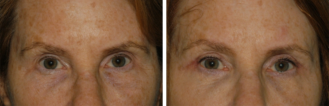 blepharoplasty eye surgery in princeton, nj