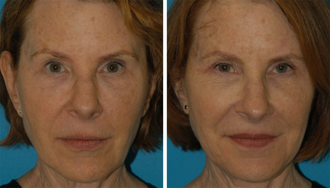 dermal filler treatment in princeton, nj