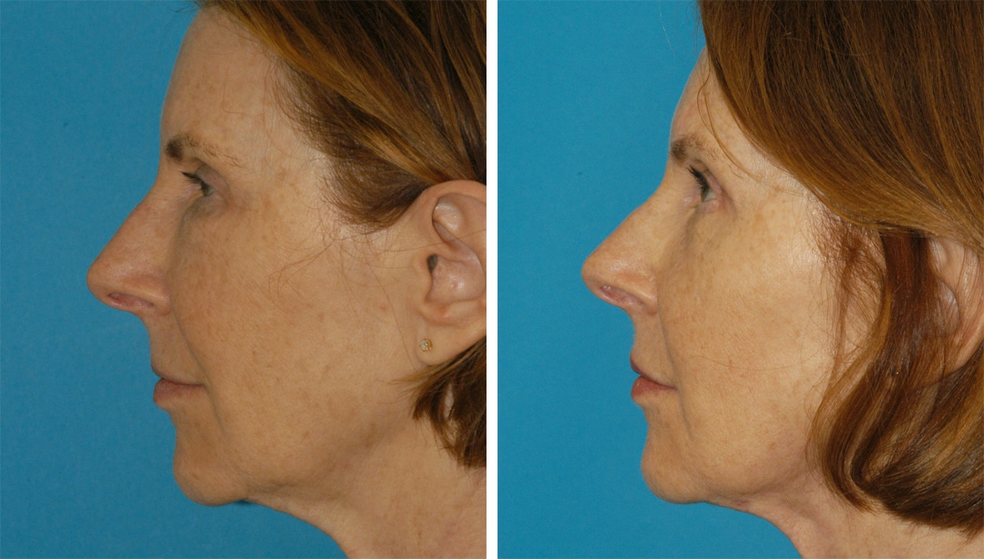 embrace rf skin tightening in princeton nj