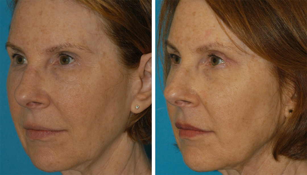 Facelift, Blepharoplasty, Embrace RF and Restylane Injections to Rejuvenate the Face restylane dermal filler injections in princeton, nj