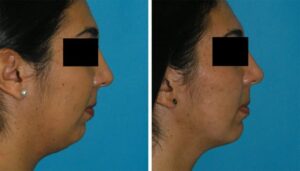 Smart Lipo treatment to remove chin fat results princeton, NJ