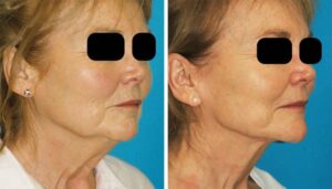 Facelift results in Princeton, NJ