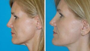 mini facelift results in Princeton, NJ