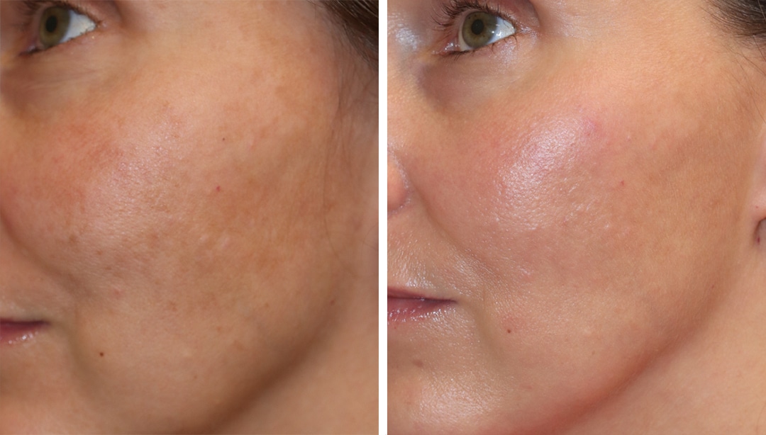 Clear+Brilliant, Pico Laser to treat acne, oily skin, and melasma. Treatment reduces brown patches and breakouts Disclaimer: Results are not guaranteed. Results vary from patient to patient.