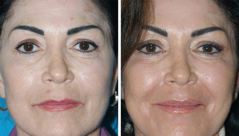 laser skin resurfacing results in Princeton, NJ