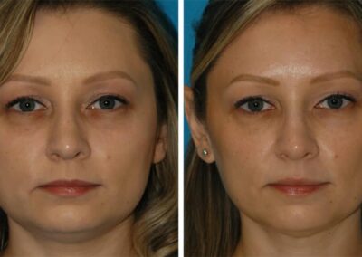 botox before and after