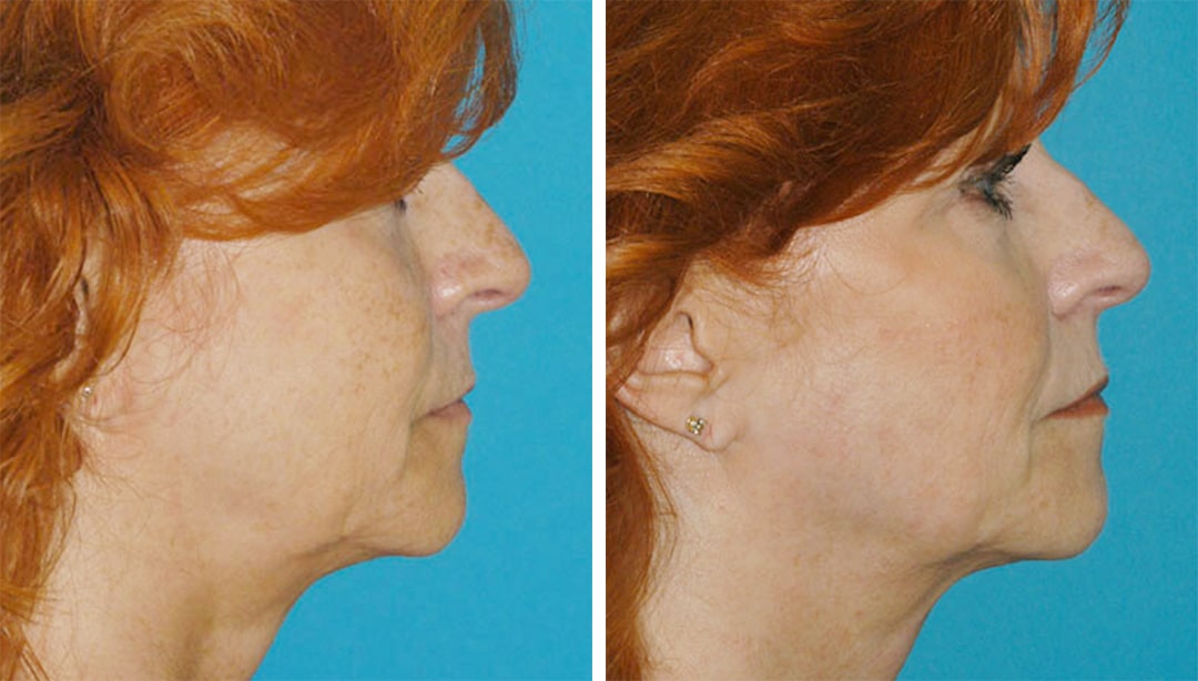 Before and after results of a patient who received a Fractora RF treatment in Princeton