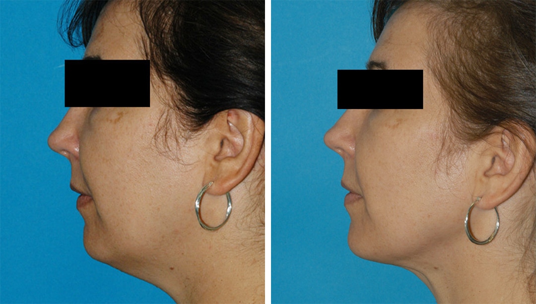 Tri-Zone Laser Lift before and after results in Princeton, NJ