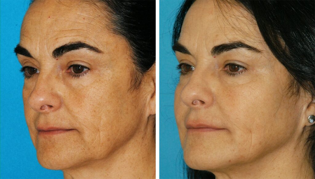 non-surgical laser lift makeover before and after results from Dr. Brunner in Princeton, NJ