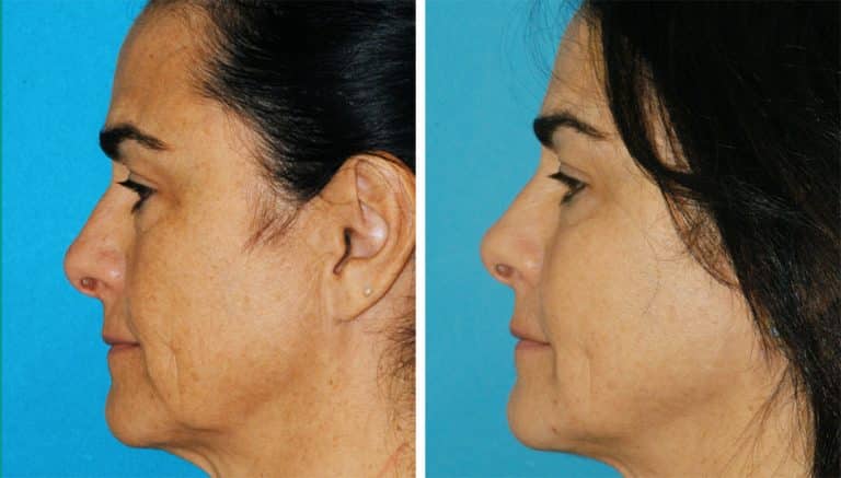 EmbraceRF- neck rejuvenation-Princeton Non-surgical neck lift results from an EmbraceRF treatment in Princeton