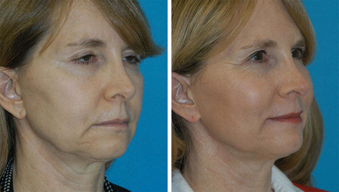 patient before and after Thermage skin tightening results in Princeton, NJ