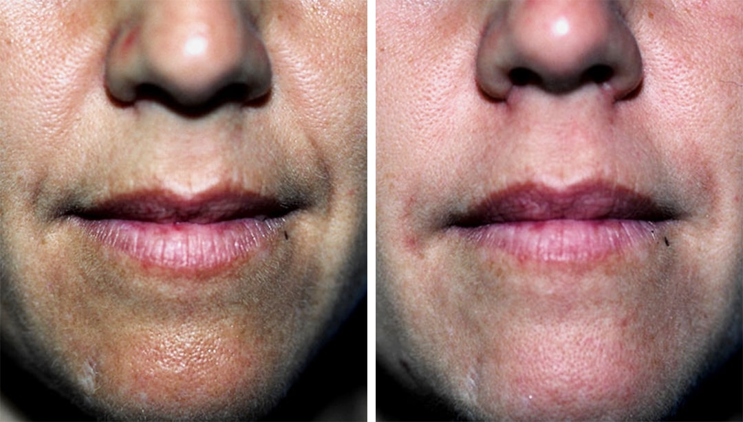 Images of a lower face of a woman comparing the results of injectables, wrinkles are greatly reduced. Injectables and fillers in Princeton, NJ