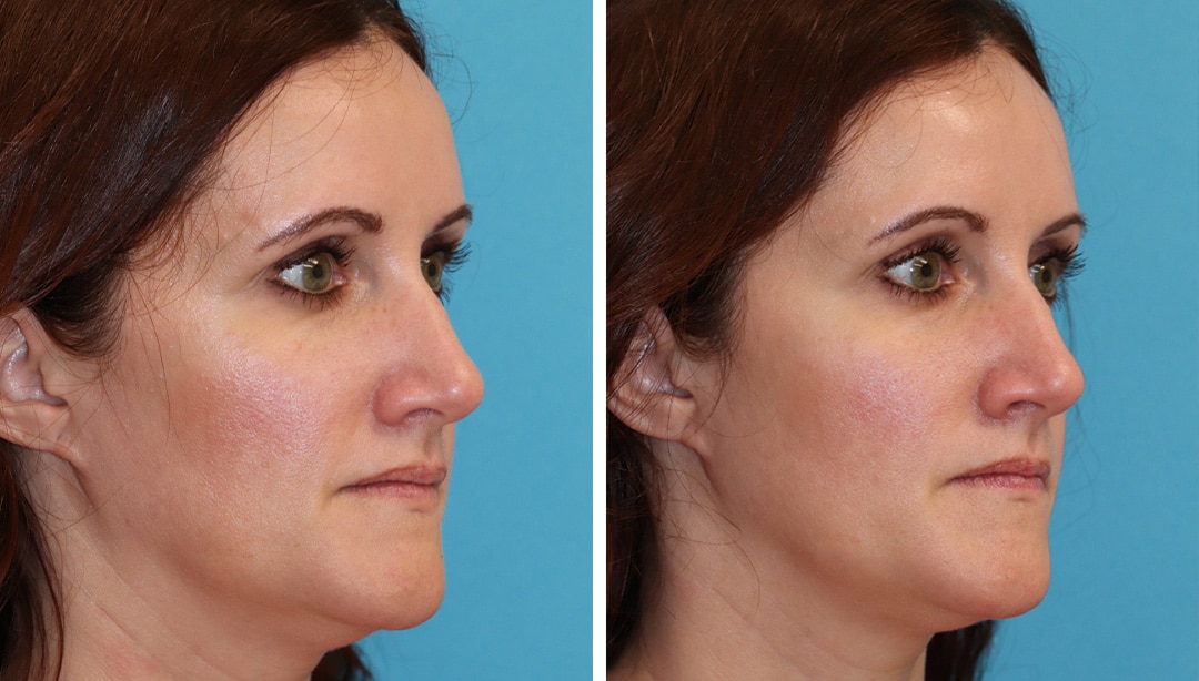 Evoke facial remodeling before and after results in Princeton