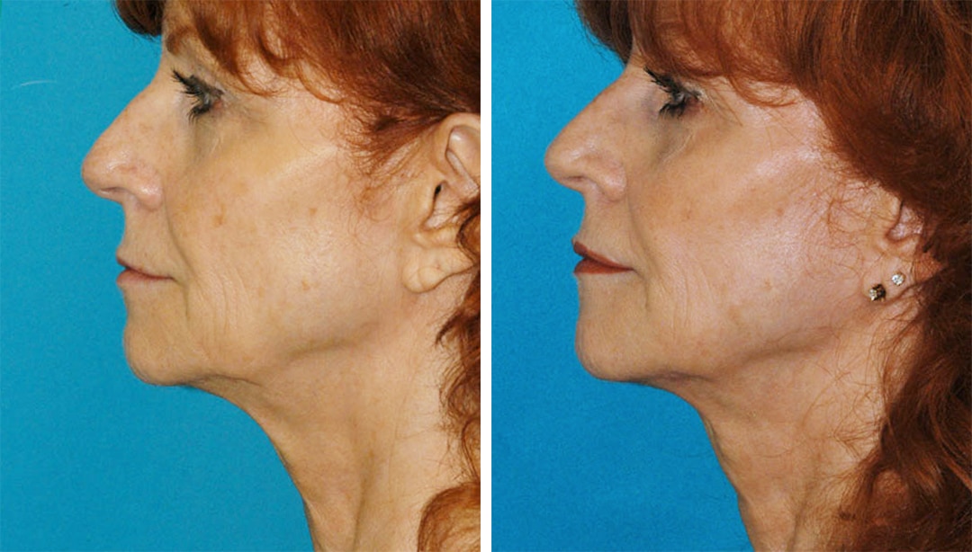 non-surgical facelift results in Princeton