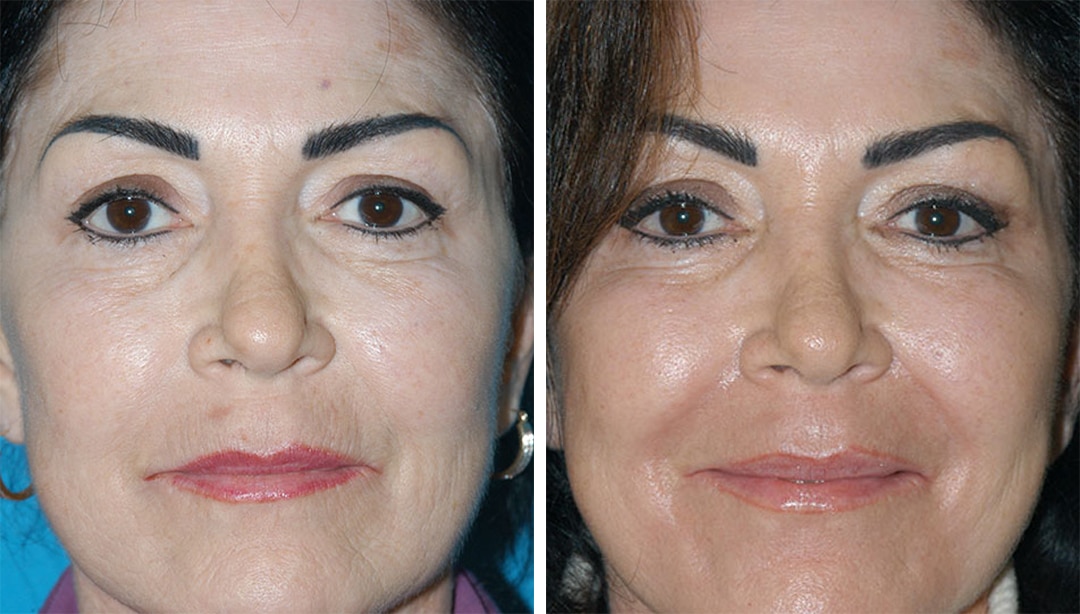 laser resurfacing treatment results in from our Princeton medical spa