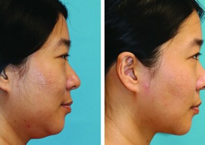 acne scar before and after