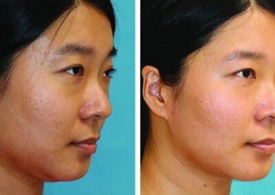 acne scar treatment before and after