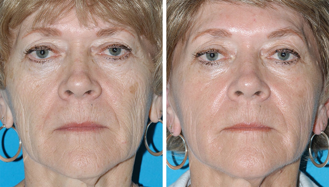 before and after patient results from a Fraxel Re-pair laser resurfacing treatment in Princeton