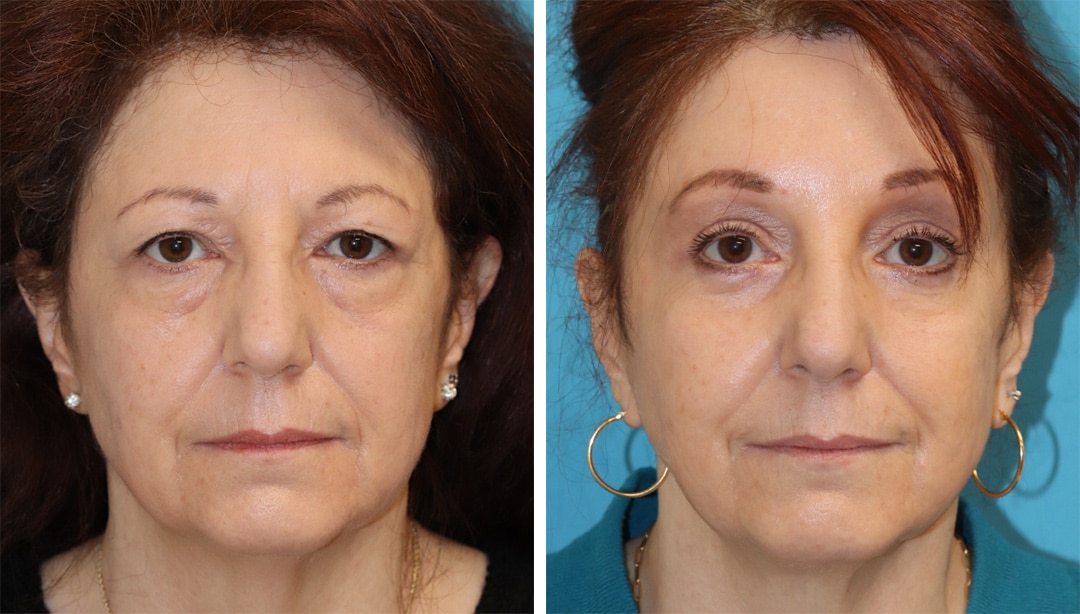 eyelift surgery results on a female patient in new jersey