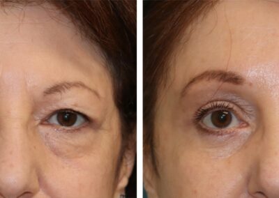 Eyelid Lift and Forehead Lift to Treat Upper and Lower Eyelids with SmartLipo Precision TX to Tighten the Jawline