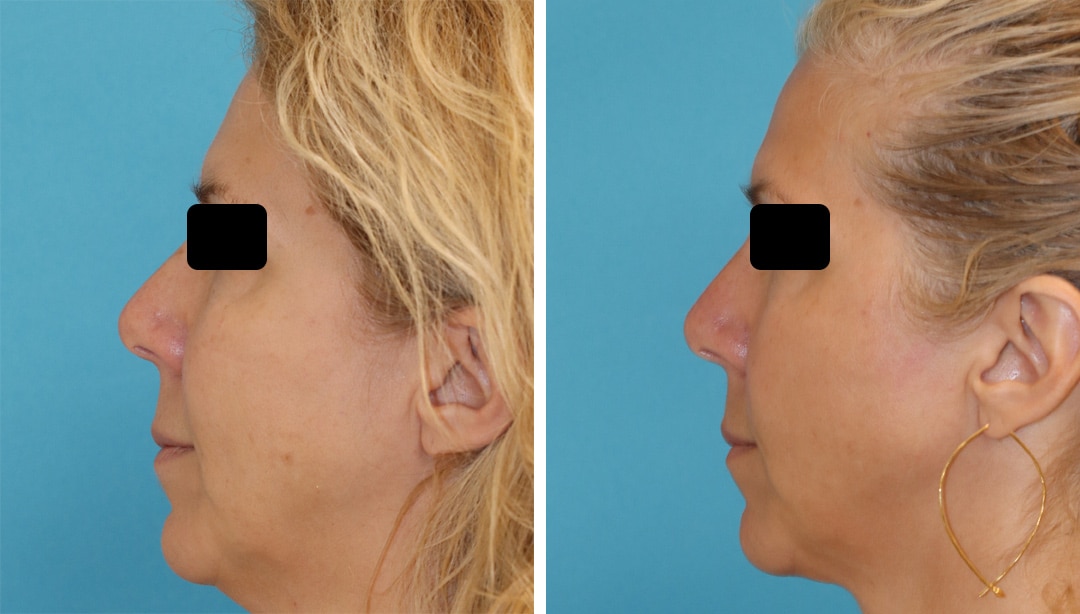 SmartLipo Precision TX to Tighten the Neck and Jawline skin tightening procedures in central jersey