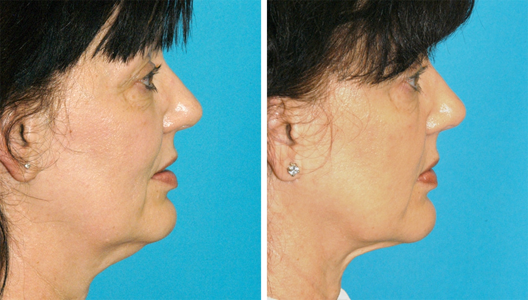smartlipo- princeton-NJ before and after neck lipo in princeton, NJ
