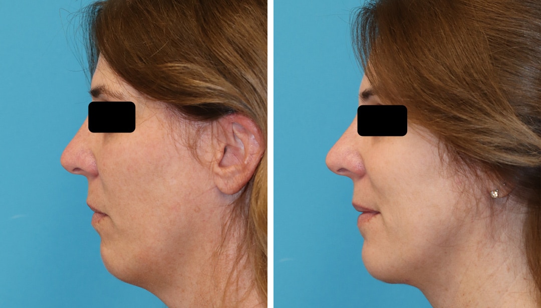 before and after results from non-surgical neck liposculpture in Princeton, NJ