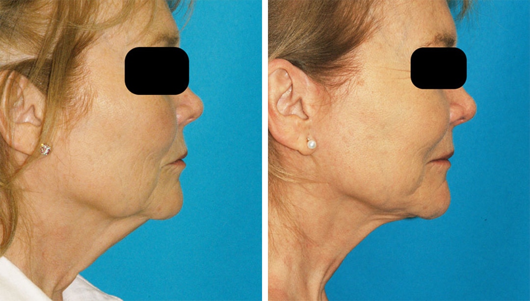 before and after results from a surgical facelift in Princeton, NJ