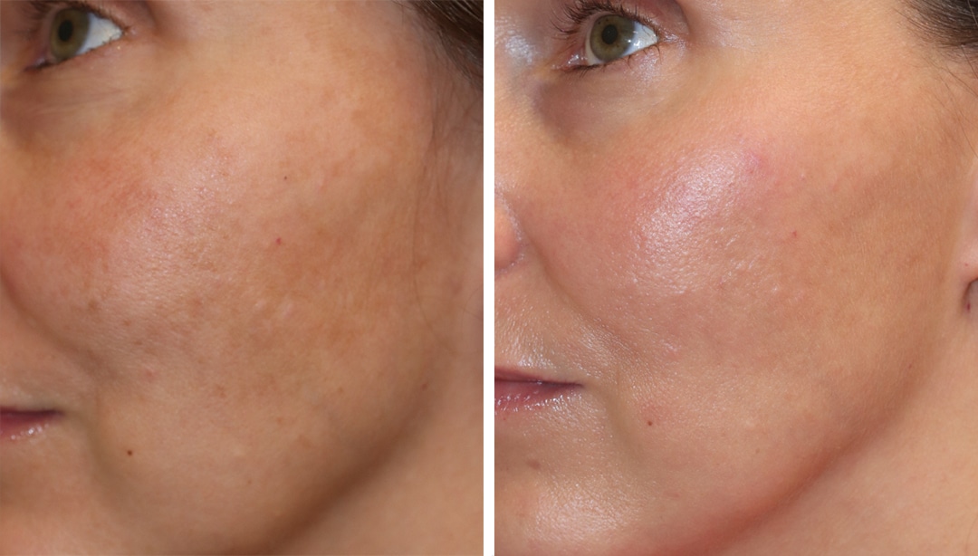 skin rejuvenation treatment - Princeton Picosure laser treatment before and after results in Princeton, NJ