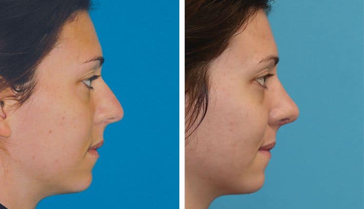 Rhinoplasty to enhance the shape and contour of the nose rhinoplasty recovery faq