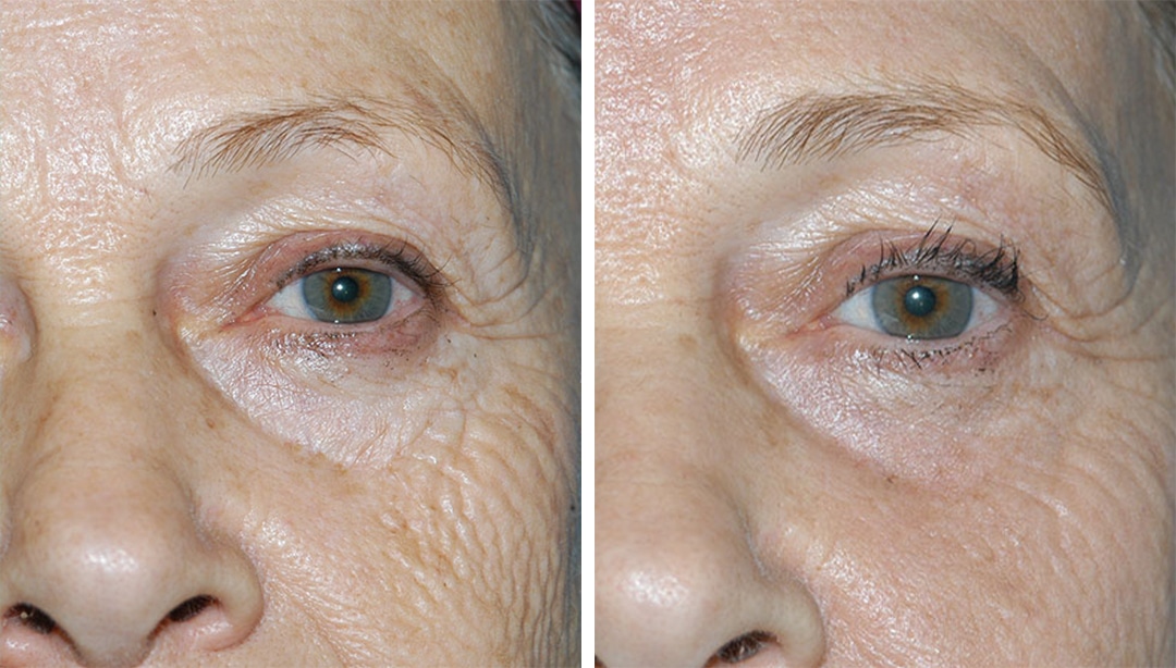 before and after results from a non-surgical facelift in Princeton