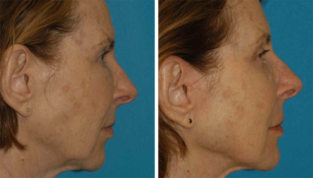 EmbraceRF skin tightening treatment results in Princeton, NJ