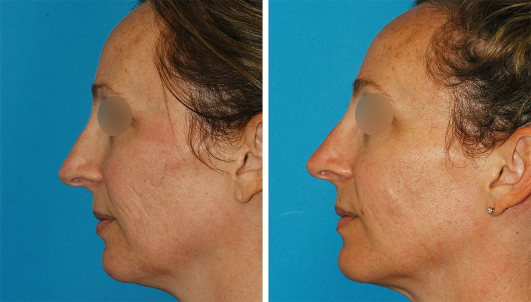 scar treatment before and after results in Princeton, NJ