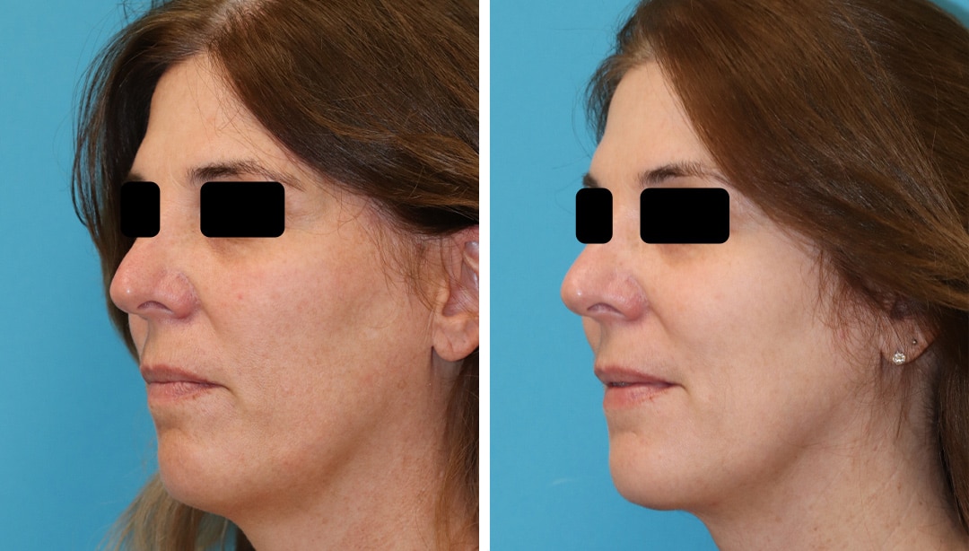 EmbraceRF jawline sculpting before and after results from Dr. Brunner in Princeton, NJ