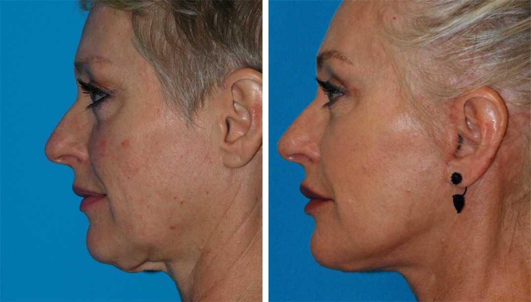 facelift - surgical skin tightening - Princeton surgical facelift before and after results in Princeton