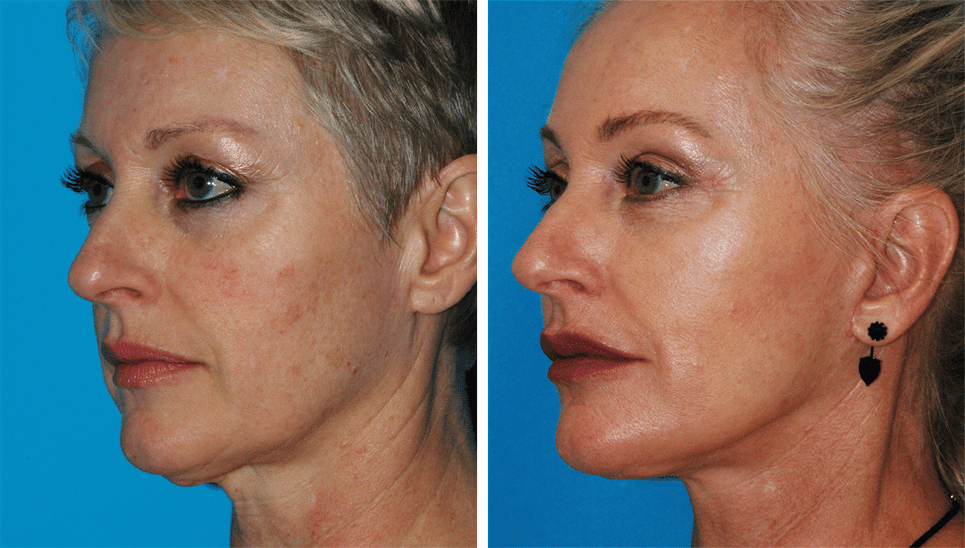 liquid facelift before and after