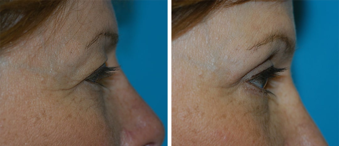 brunner-princeton-nj-blepharoplasty-eyelid-lift puffy eyes surgery in princeton nj