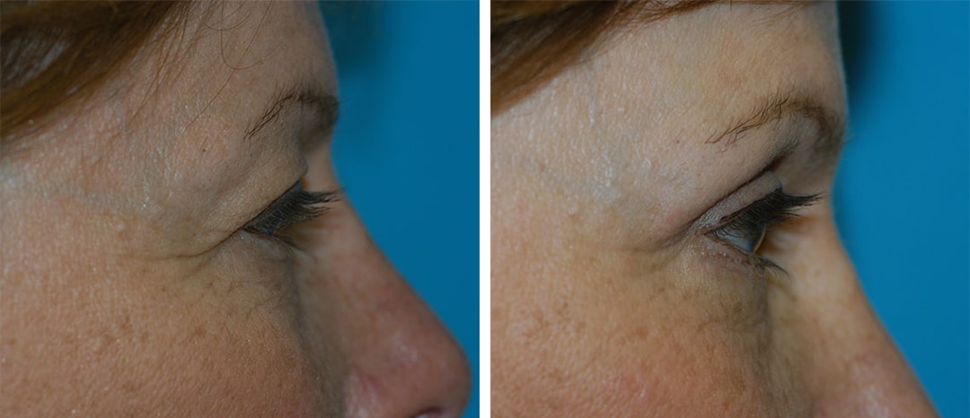 puffy eyes surgery in princeton nj