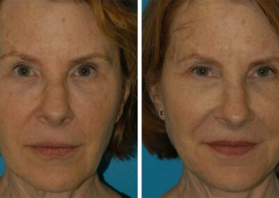 facial skin tightening