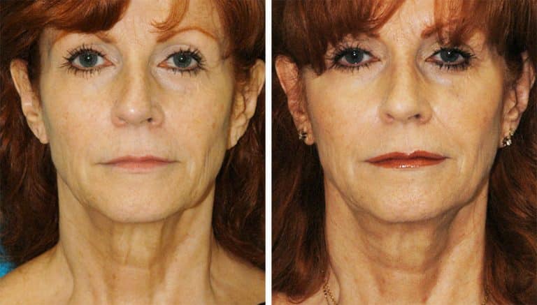 Fractora RF Fractora RF treatment results on a female patient from Princeton