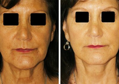 Can You Contour Your Jawline Without Surgery? - Eugenie Brunner, M.D.,  F.A.C.S