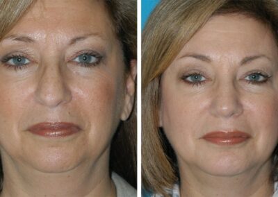 Can You Contour Your Jawline Without Surgery? - Eugenie Brunner, M.D.,  F.A.C.S