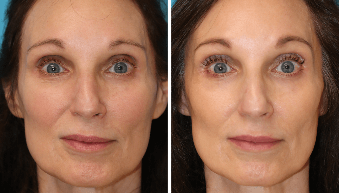 EZ PRF Gel injectable to smooth the skin beneath the eyes for a youthful appearance using patient's own blood. Disclaimer: Results vary from patient to patient. Results are not guaranteed.