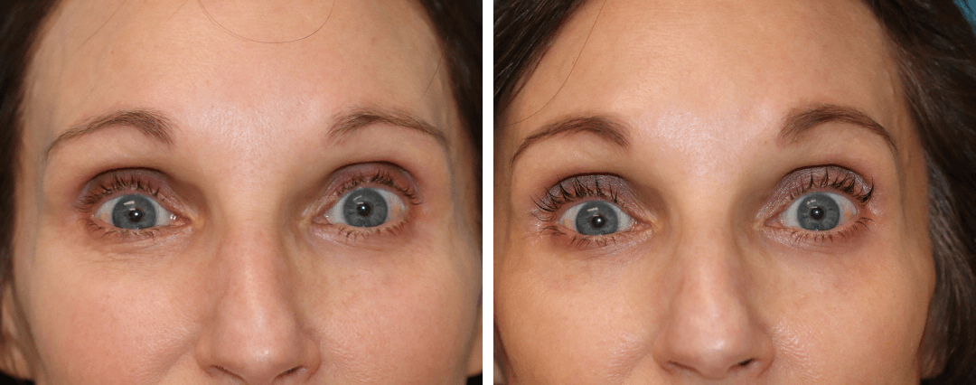 brunner-princeton-nj-ez-prf-gel-before-after2 biostimulation injectables before and after