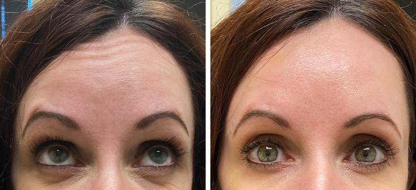 Brunner-Botox-Patient-BnA before and after botox in princeton