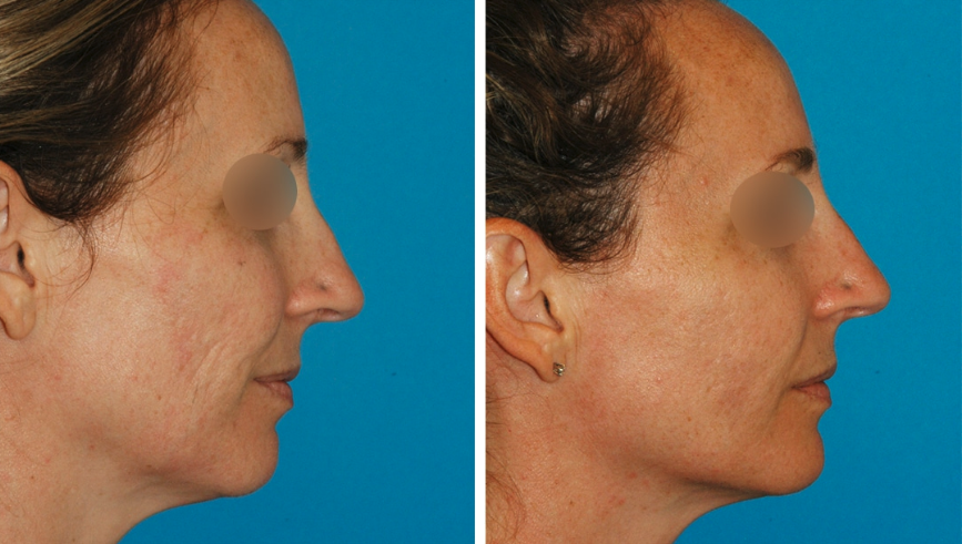 Brunner-sculptra-patient Before and after sculptra treatment in princeton, NJ